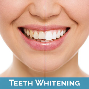 Teeth Whitening in Streamwood
