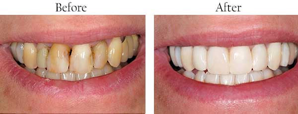 Before and After Teeth Whitening in Streamwood